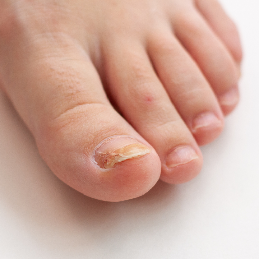 A micose na unha, também conhecida como onicomicose, é uma infecção fúngica que afeta as unhas dos dedos das mãos ou dos pés.